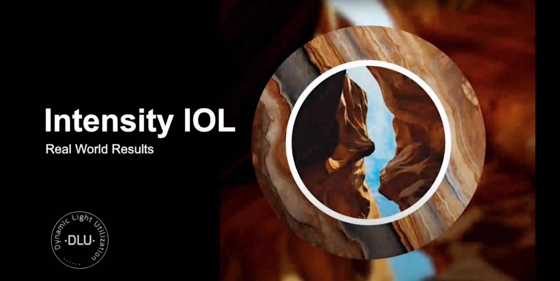 Real-World Results with Hanita Lenses' Intensity IOL- Transforming Cataract Surgery Outcomes